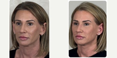 Lip Surgery before and after photo