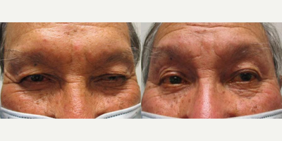 Ptosis Surgery before and after photo