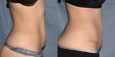 Tummy Tuck before and after photo