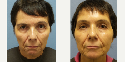 Facelift before and after photo