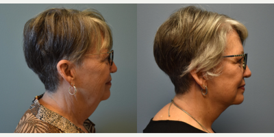 Facelift before and after photo