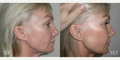 Facelift before and after photo