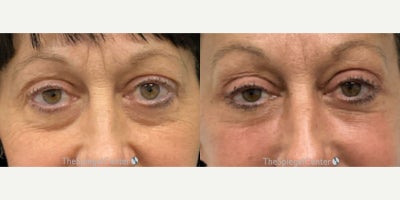 Facial Fat Transfer before and after photo