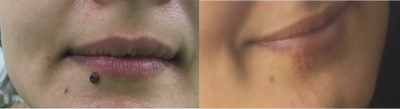 Laser Resurfacing before and after photo