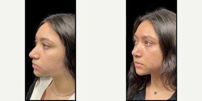 Rhinoplasty before and after photo