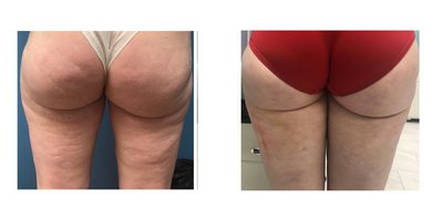 Sculptra before and after photo