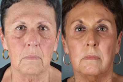 CO2 Laser before and after photo