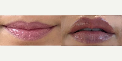 Dermal Fillers before and after photo