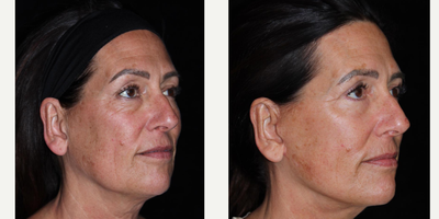 Eyelid Surgery before and after photo