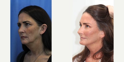 Facelift before and after photo