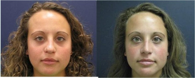 Rhinoplasty before and after photo