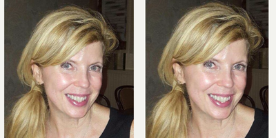 Botox before and after photo