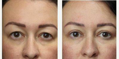 Eyelid Surgery before and after photo