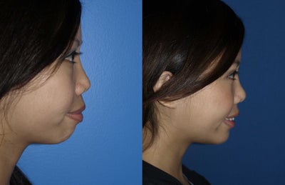Chin Implant before and after photo
