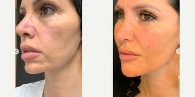Dermal Fillers before and after photo