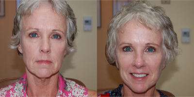 Mini Facelift before and after photo