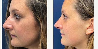 Rhinoplasty before and after photo