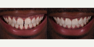 Smile Makeover before and after photo