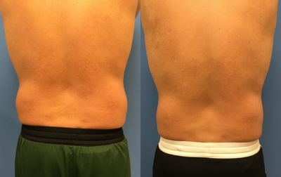 CoolSculpting before and after photo