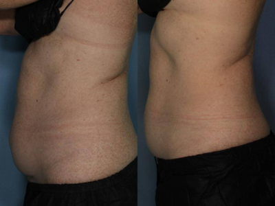 CoolSculpting before and after photo