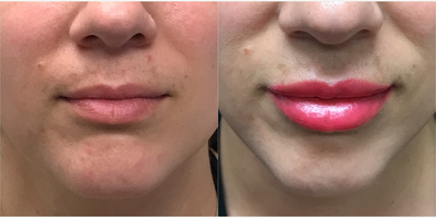 Dermal Fillers before and after photo