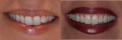 Invisalign before and after photo