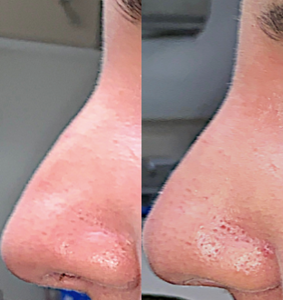 Nonsurgical Nose Job before and after photo