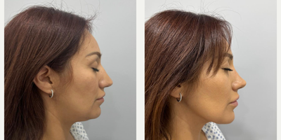 Rhinoplasty before and after photo