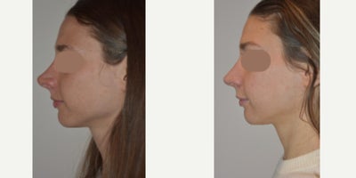 Rhinoplasty before and after photo
