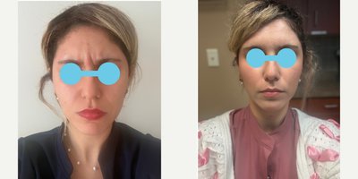 Botox before and after photo