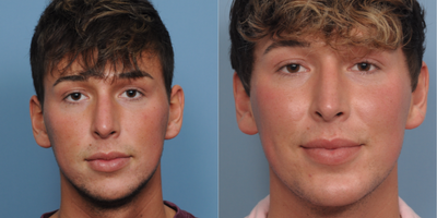 Chin Liposuction before and after photo