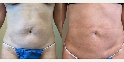 Liposuction before and after photo