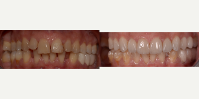 Porcelain Veneers before and after photo