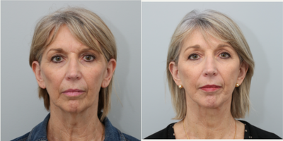 Brow Lift before and after photo