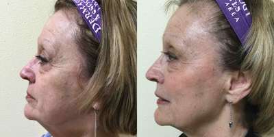 Dermal Fillers before and after photo