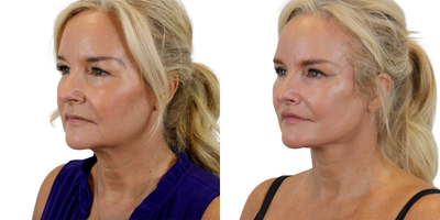Facelift before and after photo