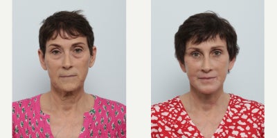 Facelift before and after photo