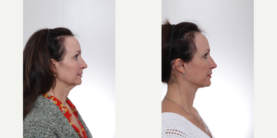 Laser Resurfacing before and after photo