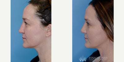 Rhinoplasty before and after photo