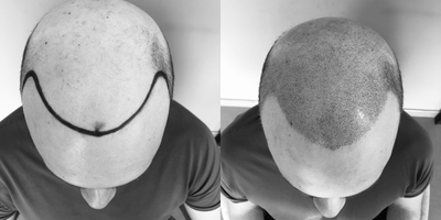 Scalp Micropigmentation before and after photo