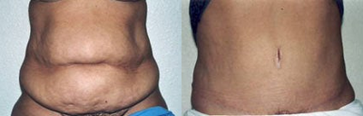 Tummy Tuck before and after photo