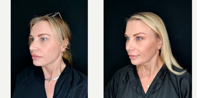 Eyelid Surgery before and after photo