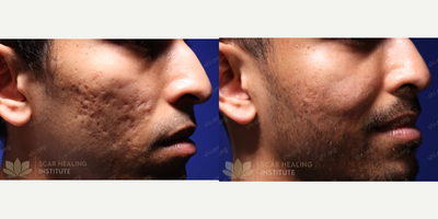 Fractional Laser before and after photo