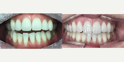 Invisalign before and after photo