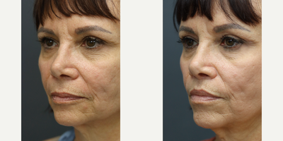 Lip Lift before and after photo
