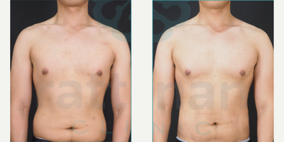 BodyTite before and after photo