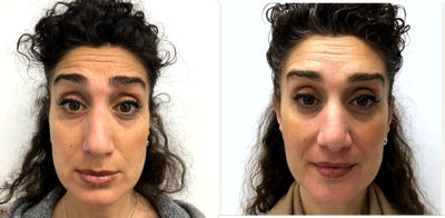 Botox before and after photo