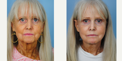 Facelift before and after photo
