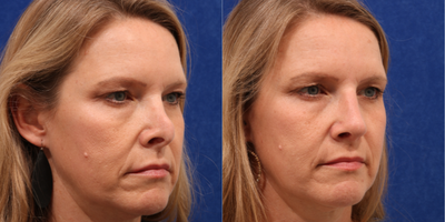 Revision Rhinoplasty before and after photo