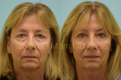Botox before and after photo